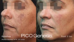 PICO Genesis before and after