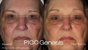 PICO Genesis before and after